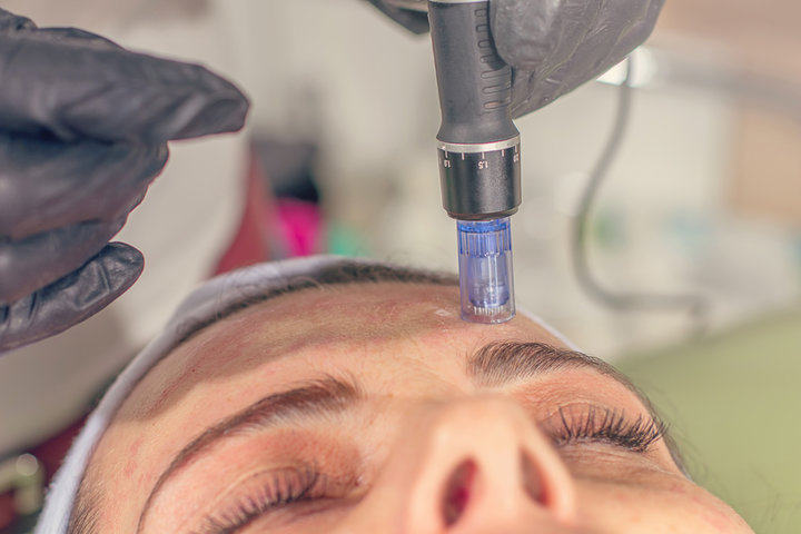 The Science Behind Microneedling with PRF: How It Works